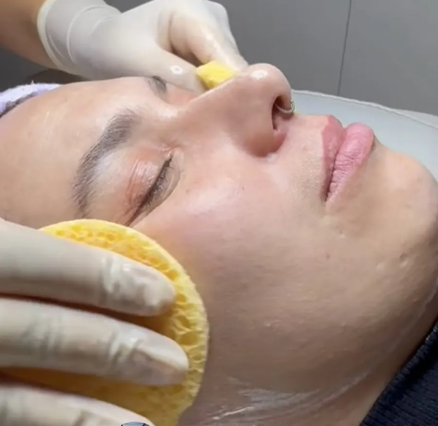 Limpieza Facial con Punta de Diamante